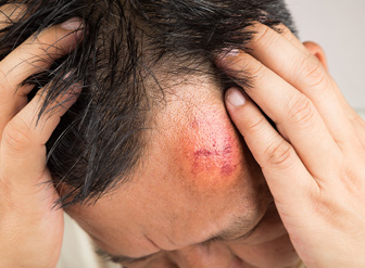 Brain Injury & Concussion Treatment Northeast Ohio - Laser Therapy Cleveland&#8482; - head